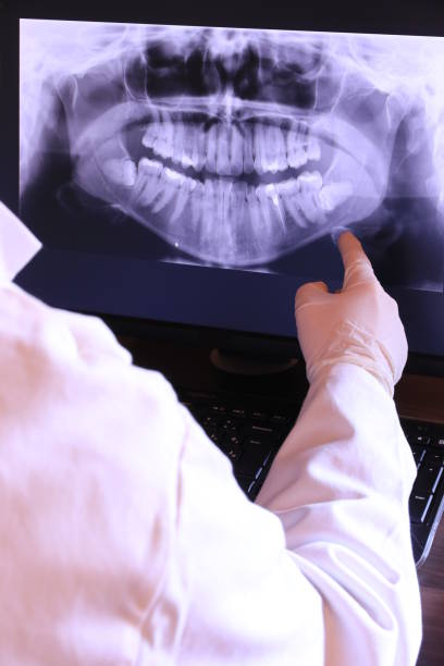 Best Emergency Wisdom Teeth Removal in Athens, GA